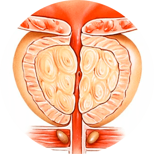 Consequences of untreated prostatitis