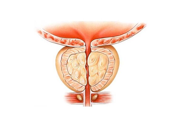 prostatitis treatment with home remedies