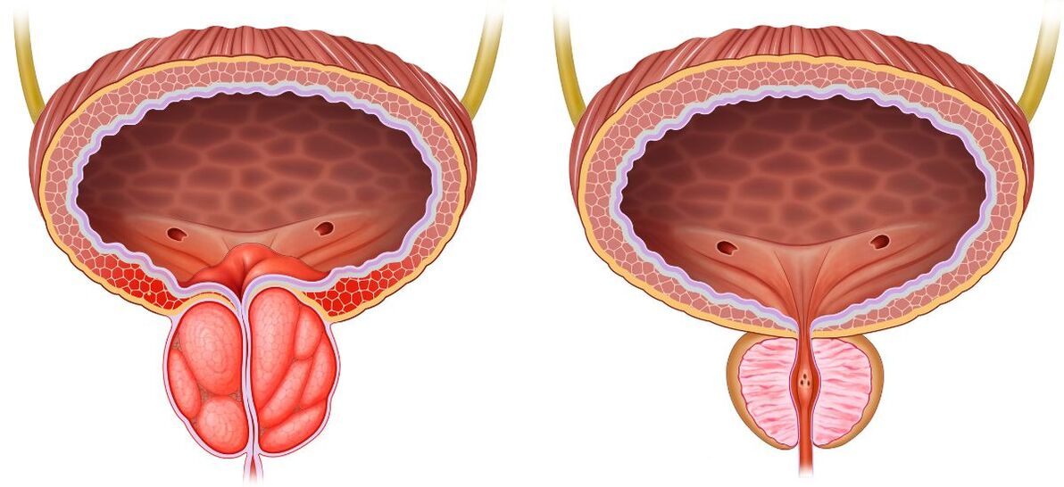 healthy and sick prostate